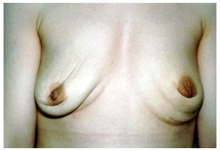 breast after implant removal