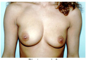ruptured breast