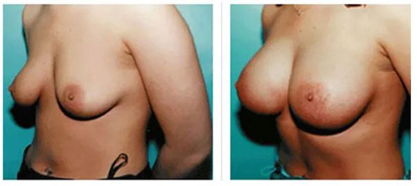 before and after picture of breast proceedure.